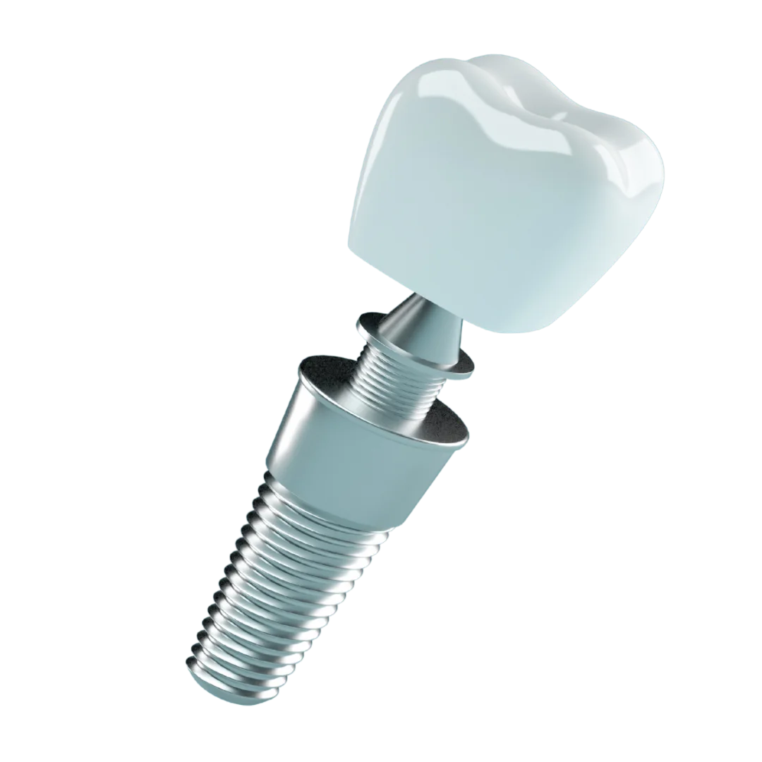 implante imagen Implantes dentales en CABA